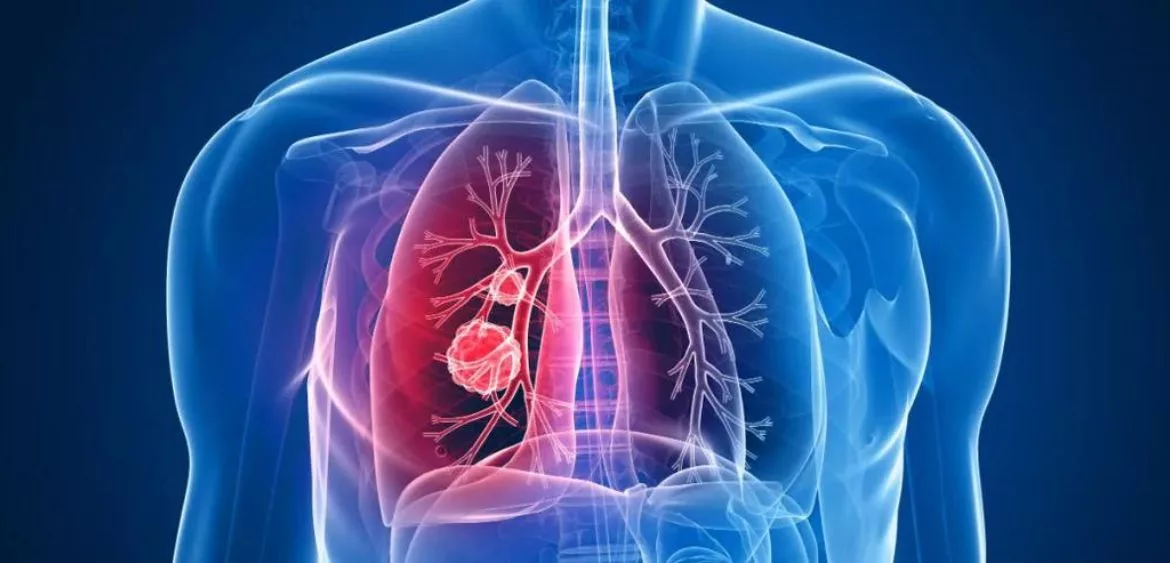 Lung Cancer